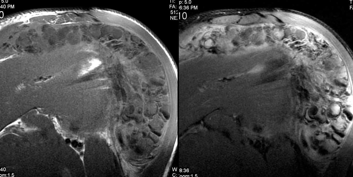 Figure 4 for case tumoral calcinosis ( RID5202 )